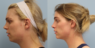Chin Implant before and after photo
