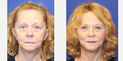 Facelift before and after photo
