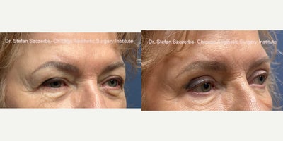 Eyelid Surgery before and after photo
