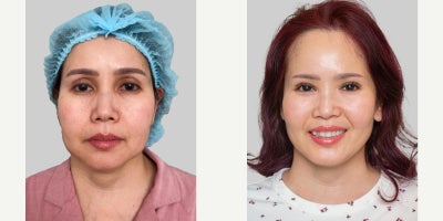 Eyelid Surgery before and after photo