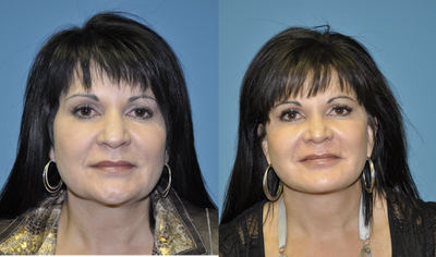 Facelift before and after photo