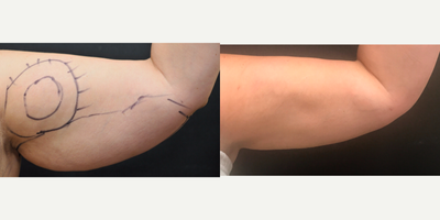 Laser Liposuction before and after photo