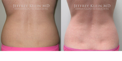SculpSure before and after photo