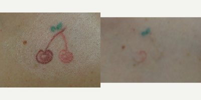 Tattoo Removal before and after photo