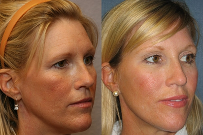 Brow Lift before and after photo