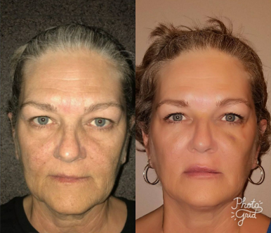 Dermal Fillers before and after photo