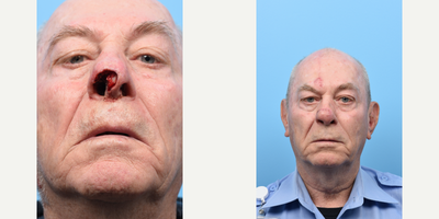Facial Reconstructive Surgery before and after photo