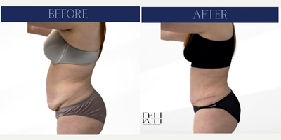 Liposuction before and after photo
