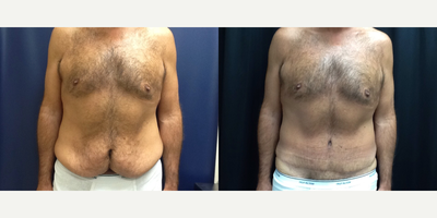 Male Tummy Tuck before and after photo