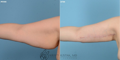 Arm Lift before and after photo