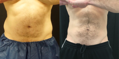 CoolSculpting before and after photo