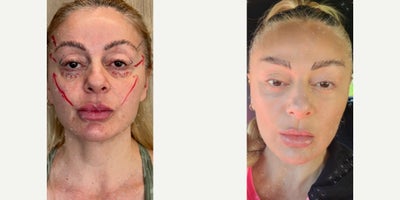Facelift before and after photo