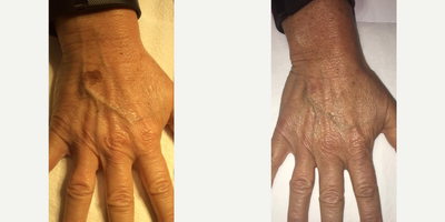 Hand Rejuvenation before and after photo