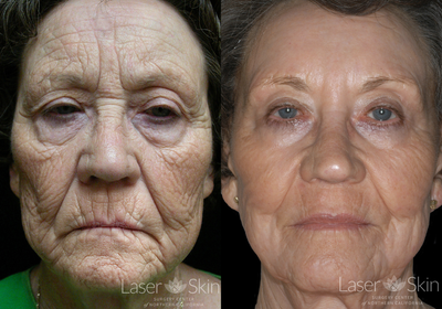 Laser Resurfacing before and after photo