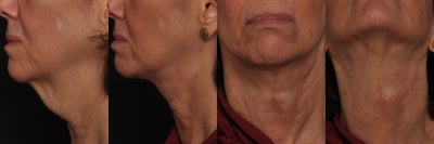 Neck Lift before and after photo