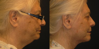 Neck Lift before and after photo
