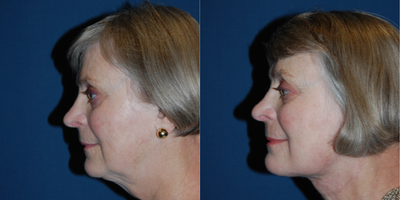 Neck Lift before and after photo