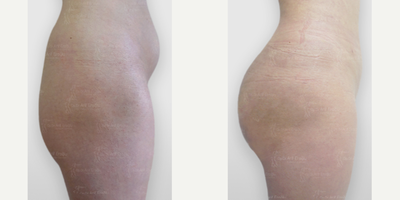 Brazilian Butt Lift before and after photo