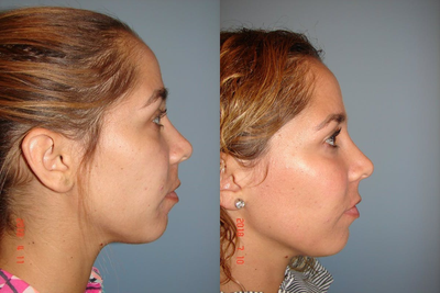 Cheek Augmentation before and after photo