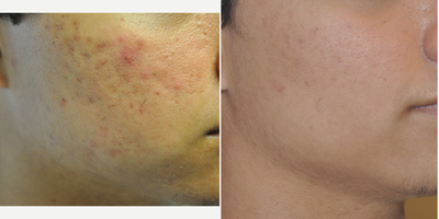 Laser Genesis before and after photo