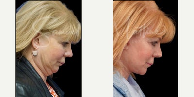 Neck Lift before and after photo