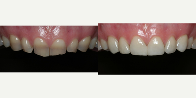 Porcelain Veneers before and after photo