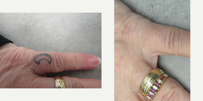 Tattoo Removal before and after photo