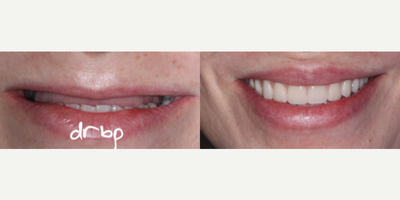Dental Implants before and after photo