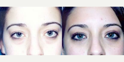 Eyelid Surgery before and after photo