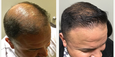 Hair Transplant before and after photo