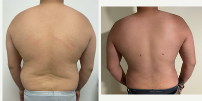 Liposuction before and after photo