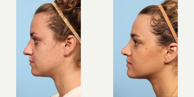 Rhinoplasty before and after photo