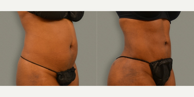 Liposuction before and after photo