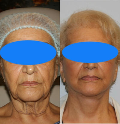 Neck Lift before and after photo