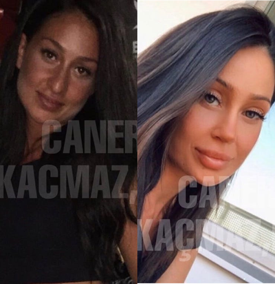 Rhinoplasty before and after photo