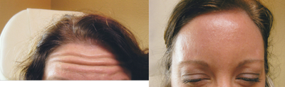 Botox before and after photo