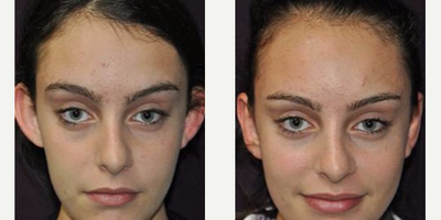 Ear Surgery before and after photo