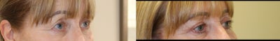 Eyelid Surgery before and after photo