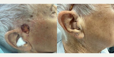 Mohs Surgery before and after photo