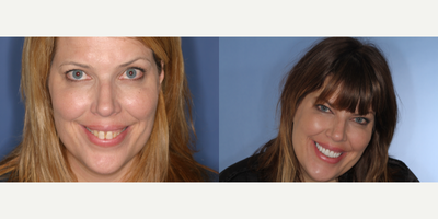 Smile Makeover before and after photo