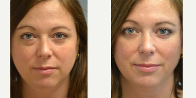 Eyelid Surgery before and after photo