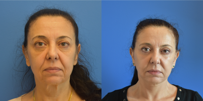 Facelift before and after photo