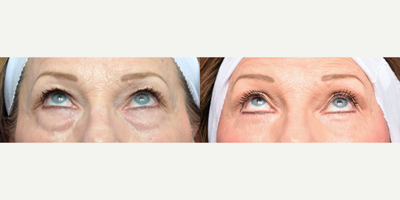 Facelift before and after photo