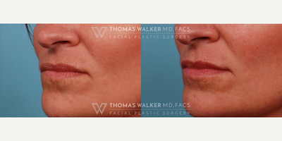 Juvederm before and after photo