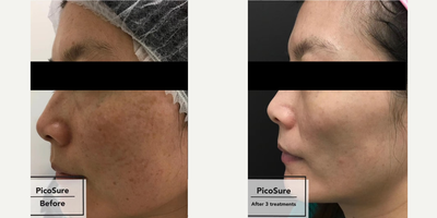 PicoSure before and after photo
