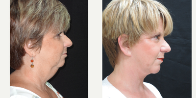 Facelift before and after photo