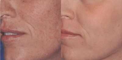 Laser Resurfacing before and after photo