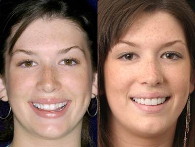 Smile Makeover before and after photo