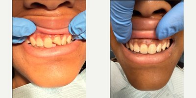 Tooth Repair before and after photo