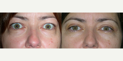 Eyelid Retraction Repair before and after photo